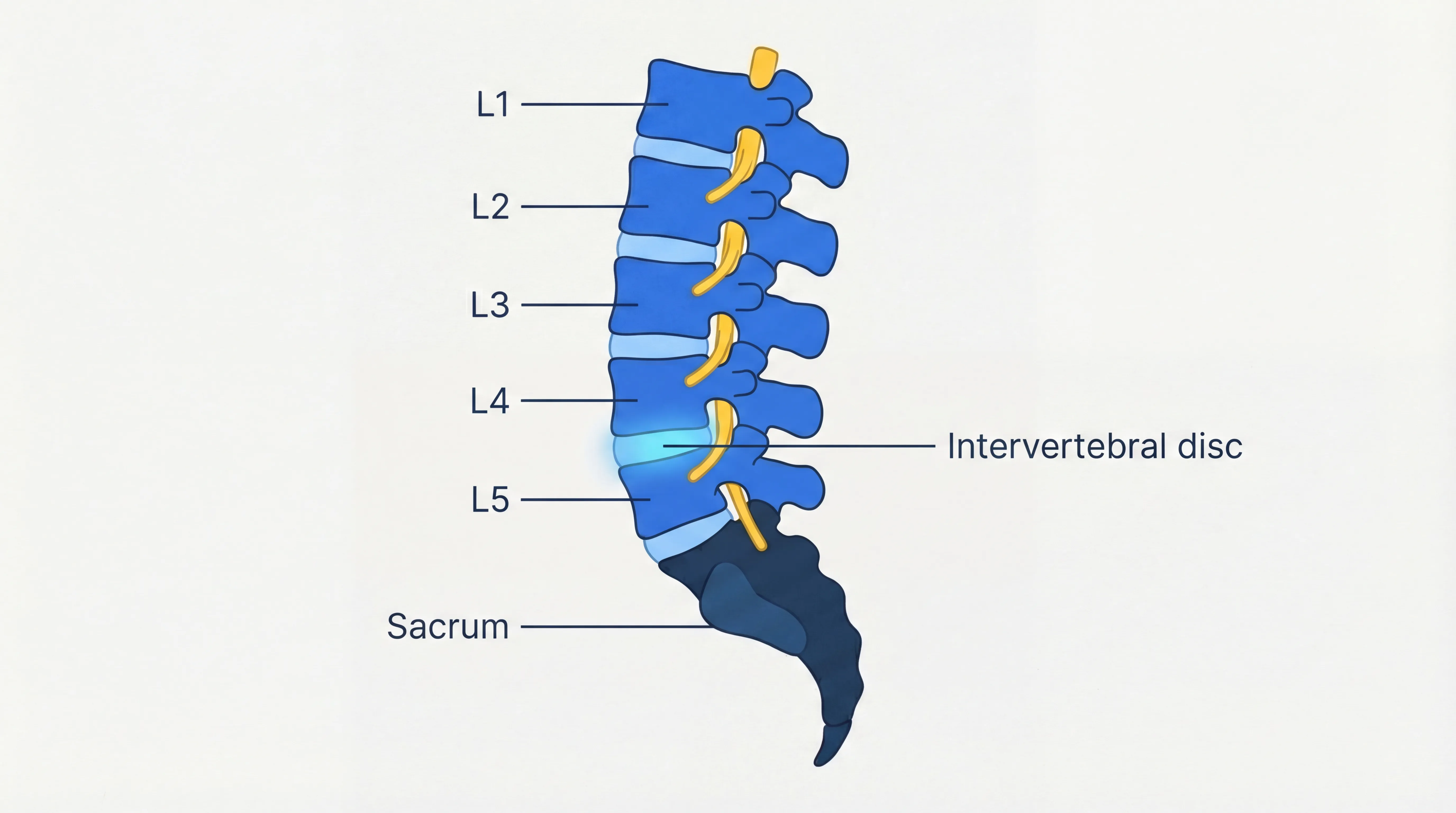 Medical illustration of lumbar spine showing L1-L5 vertebrae, intervertebral discs, and sacrum